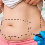 Debunking Myths: Does Liposuction Really Cause Loose Skin?
